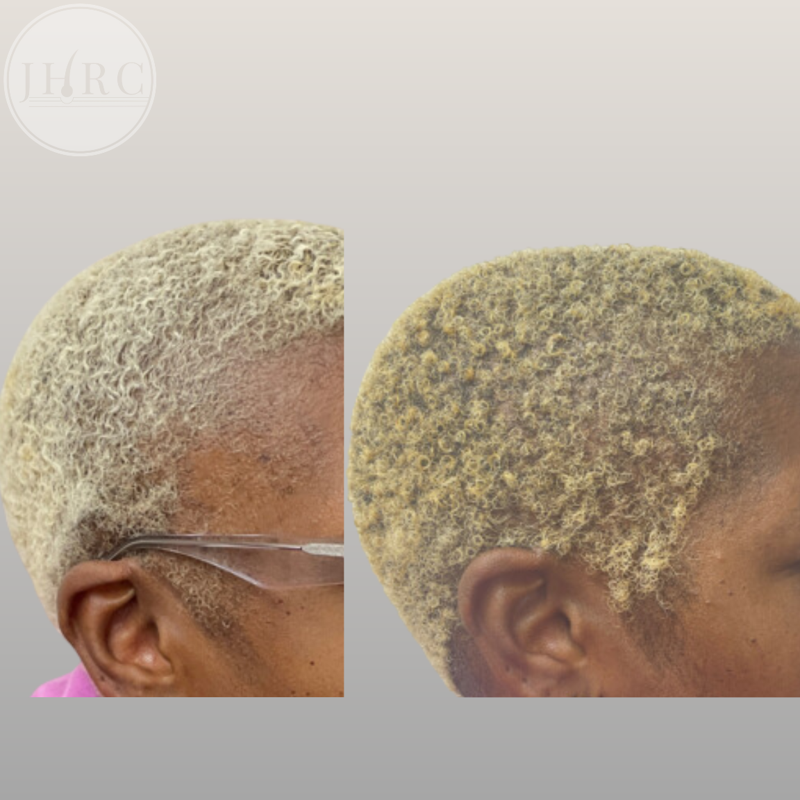 female hair restoration transplants raleigh nc