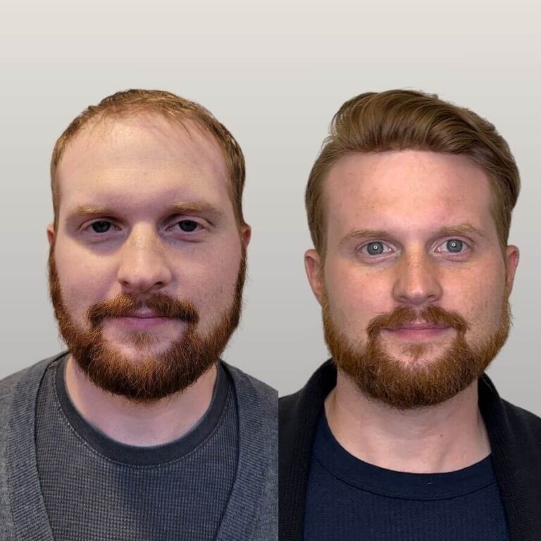 Hair Restoration Raleigh