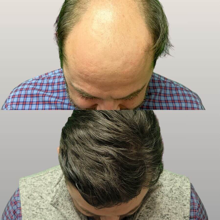 Hair Restoration Raleigh