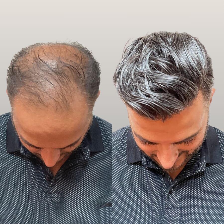 Hair Restoration Raleigh