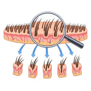 Simple illustration of donor tissue being separated into individual follicular-unit grafts under magnification