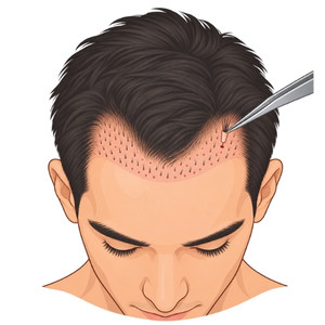 Simple illustration of the front of a head with hair grafts being placed into recipient sites using forceps